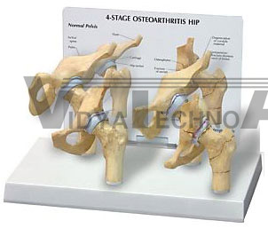 Hip Joint 4 Stage Model Arthritic